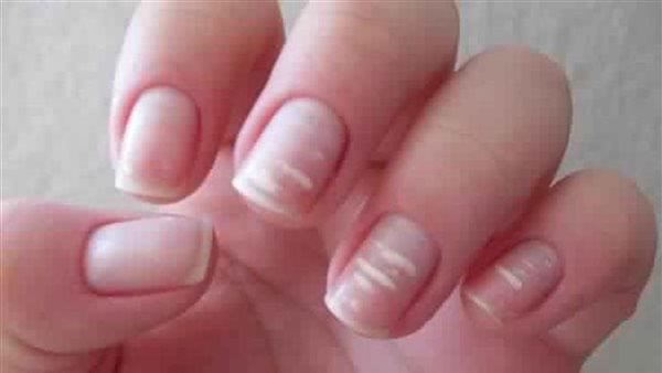 ورم خطير.. تحذير عاجل من علامة تحت الأظافر ظهرت على سيدة