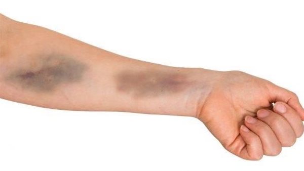 اذهب للطبيب فورًا إذا ظهرت هذه الأنواع من الكدمات المجهولة على جسمك