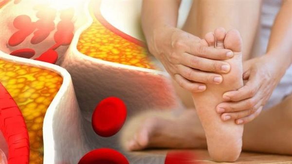 لا تتجاهلها.. علامات خطيرة في ساقيك تكشف أن الكوليسترول أصبح قاتلًا
