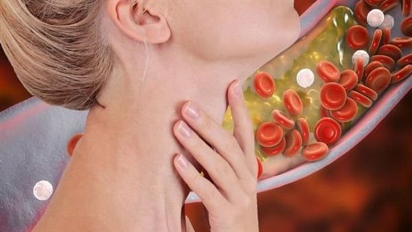 خد بالك..3 أعراض تستطيع شمها تكشف عن ارتفاع نسبة الكوليسترول