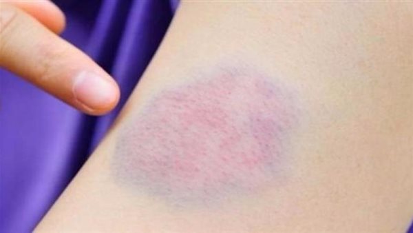 تشير لمرض خطير..تحذير عاجل من ظهور علامات زرقاء بالجسم