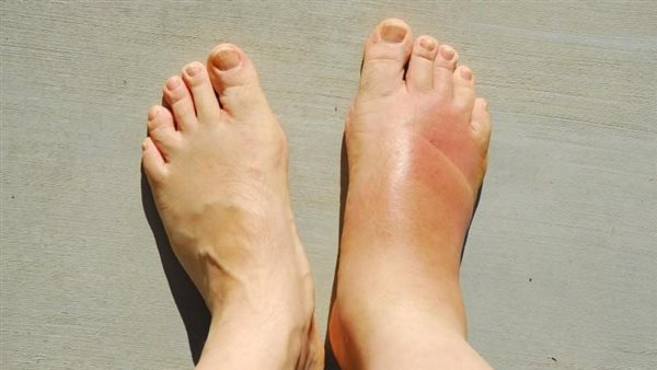 خد بالك.. علامات تحذيرية في قدميك تخبرك أن كبدك في ورطة