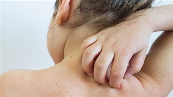 بينها طفح جلدي حول الأعضاء التناسلية.. الصحة تكشف أعراض الإصابة بفيروس جدري القرود