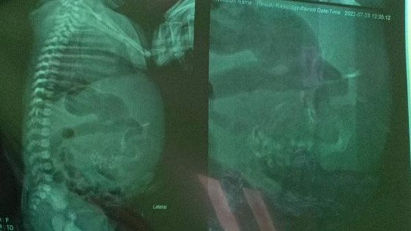 تفاصيل مثيرة.. حالة نادرة لطفلة مولودة تحمل جنينًا في بطنها بالدقهلية | شاهد