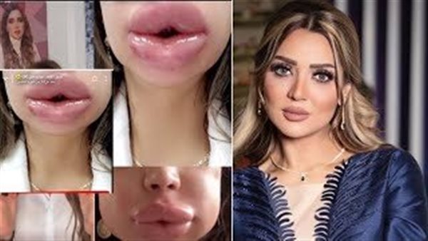 صدمت جمهورها بتشوه شفايفها.. من هي الفنانة عبير أحمد؟ | شاهد