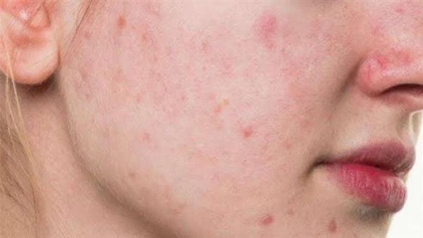 استشاري جلدية توضح..أسباب ظهور حب الشباب والطرق الصحيحة لعلاجها