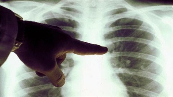 شائعة ويجب فحصها بهذه الأشعة.. أعراض وأسباب سرطان الرئة | فيديو