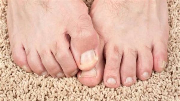 مضاعفات تصل للوفاة.. أعراض في القدمين تجبرك على الذهاب للمستشفى فورا