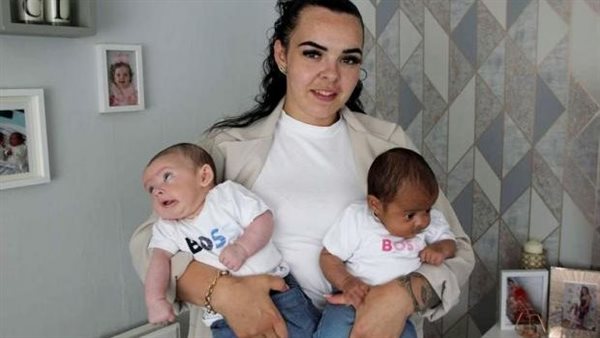 بتحصل مرة في المليون.. حالة ولادة نادرة لتوأم تثير الدهشة | شاهد