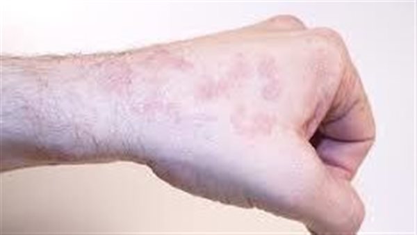 توجه للطبيب فورًا.. 8 علامات تحذيرية تكشف أنك مصاب بسرطان الجلد 