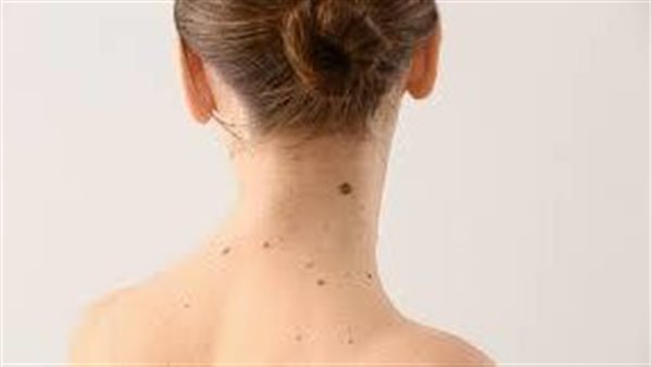 ظهور الشامات بالجسم.. 6 علامات تعني أنها خطر وتستدعي زيارة الطبيب