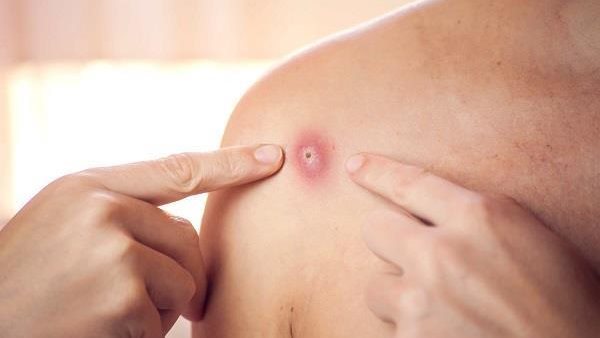  جدري القرود.. الأعراض وطرق الوقاية بعد اكتشاف أول حالة في مصر 