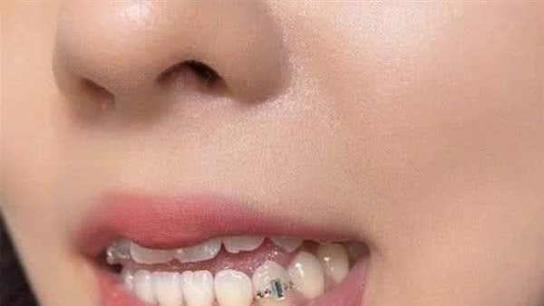 بينها الفواكه المجففة والحلويات.. تحذير من أطعمة تسبب تسوس الأسنان