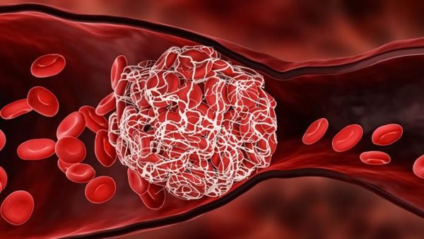 احذرها..5 أطعمة قد تمنع الدم من الحركة وتسبب جلطات دموية خطيرة