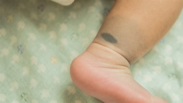 مؤشر للإصابة بمرض خطير..أسباب ظهور بقع زرقاء في الجسم عند الأطفال | فيديو 