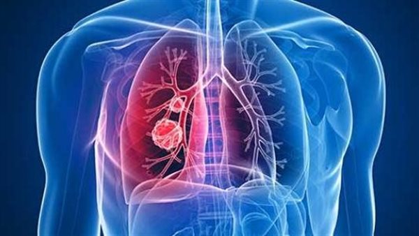 احذرها.. هذه الأعراض تنذر بسرطان الرئة