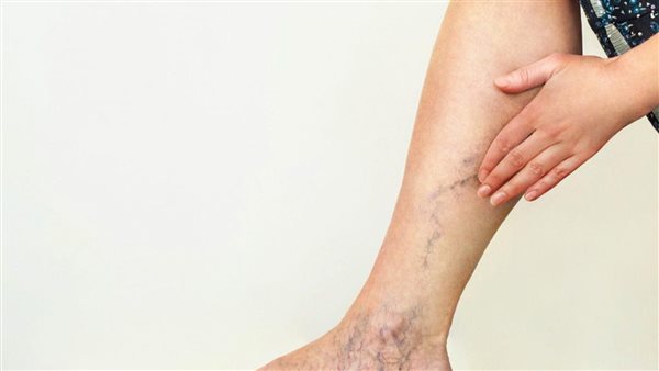  احذرها.. 3 مشروبات شائعة قد تسبب انتفاخ وتضخم أوردة الساق