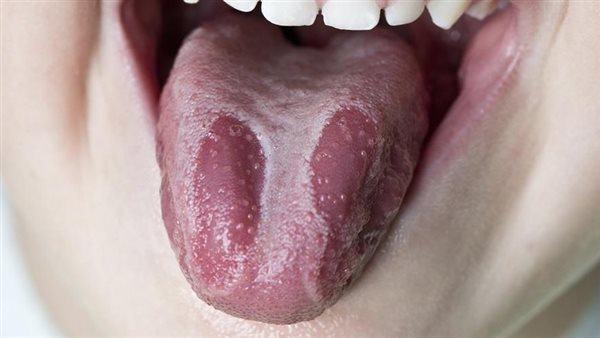 احذر منها.. 5 علامات على اللسان تعني الإصابة بأمراض خطيرة