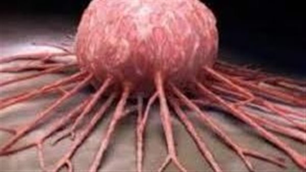 تهدد حياتك.. احذر علامة شائعة تكشف الإصابة بالسرطان 