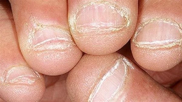 ينتقل عادة بالاتصال الجنسي.. ما هو مرض الزهري؟