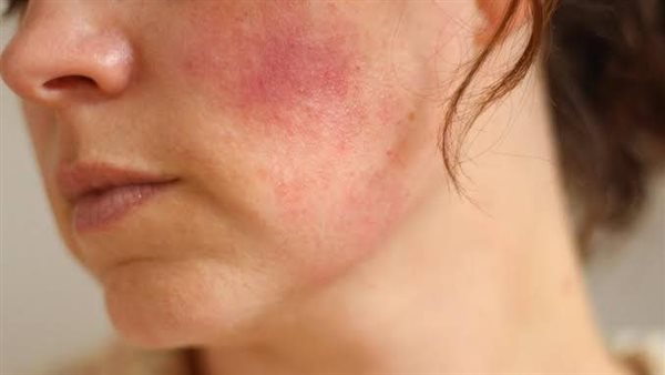 خد بالك..أسباب ظهور البقع الحمراء على الجسم