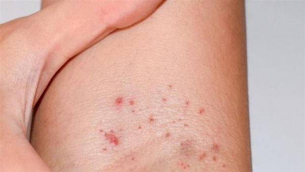 احذر المضاعفات..5 أسباب لظهور البقع الحمراء على الجسم