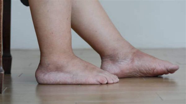 احذر.. هذه الأعراض تنذر بمتلازمة القدم السكري
