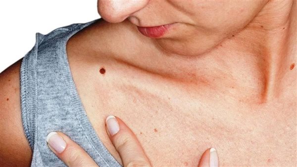 في هذه الحالة توجه للطيب فورًا..8 علامات تحذيرية تكشف الإصابة بسرطان الجلد