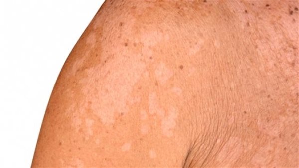 اشرب الماء بكثرة.. أسباب الإصابة بالتينيا الملونة وطرق علاجها