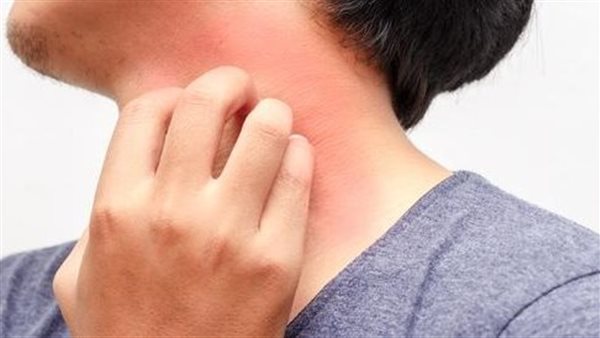 قد تكون علامة على الإصابة بالسرطان.. احذر من الحكة المستمرة