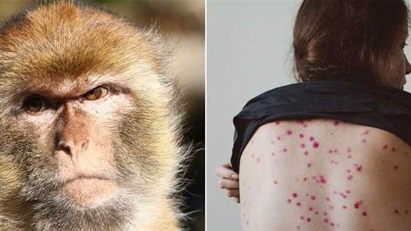 من بينها تعطيل الدراسة.. 25 إجراء تتخذه الحكومة لمواجهة انتشار جدري القرود