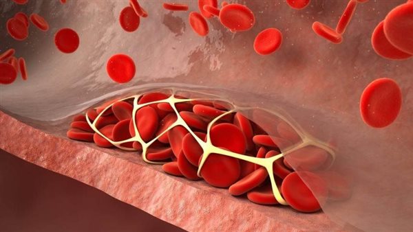 رجل يكتشف أعراض غريبة.. هل الطفح الجلدي علامة على الإصابة بجلطة دموية؟ 