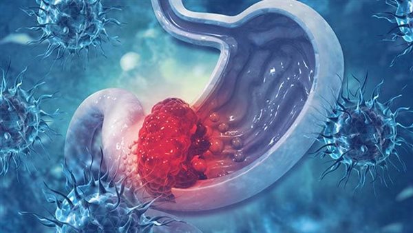 احذرها.. علامة تظهر في العينين تنذر بسرطان خطير