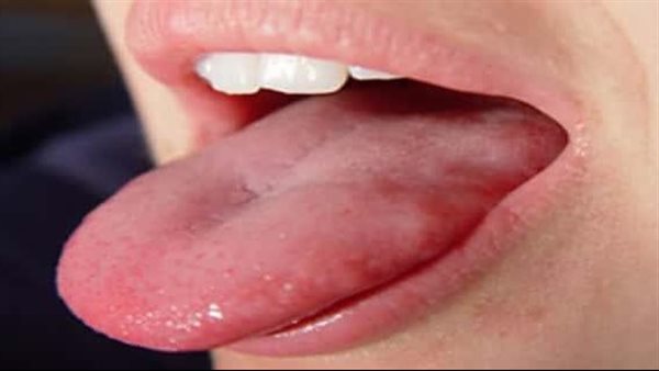 خد بالك..عرض شائع يظهر على لسانك يكشف إصابتك بارتفاع الكوليسترول 