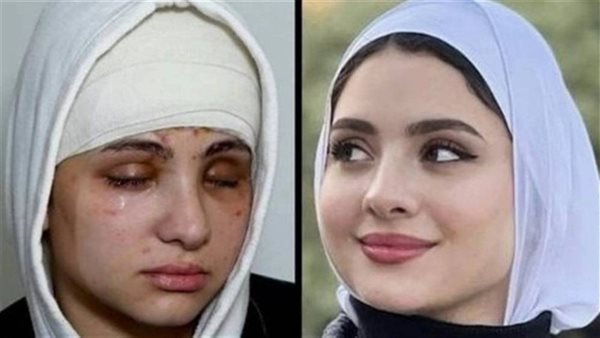 الشبكية سايحة.. تفاصيل صادمة عن حالة البلوجر سارة محمد وإصابتها بالعمى