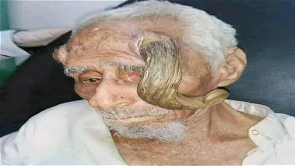 رأسه بـ قرنين.. سبب مفاجئ لوفاة معمر يمني عمره 140 عامًا | فيديو