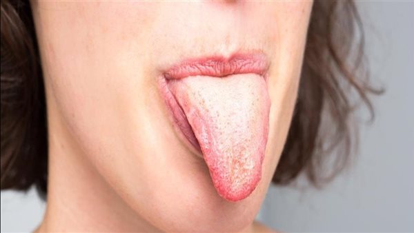 لن تتوقع.. هذا ما تشير إليه البقع البيضاء على اللسان