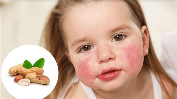 تعرف عليها.. أعراض حساسية الفول السوداني