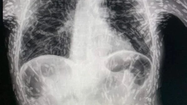  يصدم الملايين.. فيديو لطبيب يثير الجدل على وسائل التواصل الاجتماعي لهذا السبب | شاهد