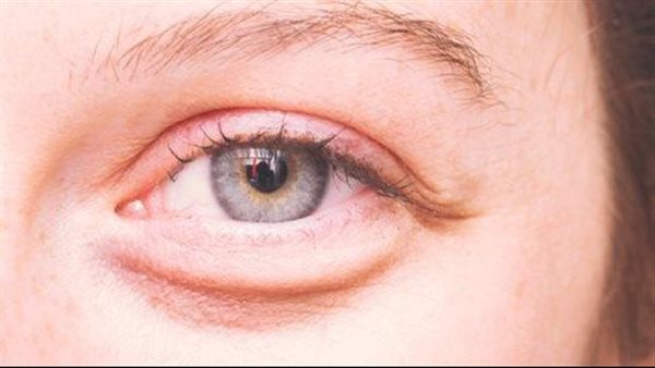 يظهر في عينيك.. أعراض صامتة لـ ارتفاع الكوليسترول الخطير