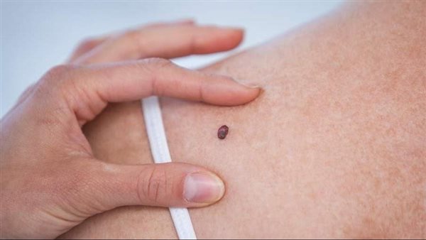 احذرها..علامة تظهر على جبهة امرأة تشير إلى إصابتها بسرطان قاتل