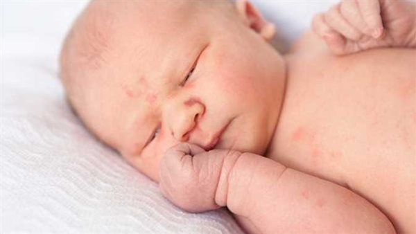 بعد فزع جروبات الماميز.. ما تأثير الحمى الوردية على طفلك؟ 