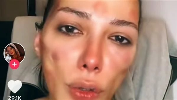 الدكتور قاللي عندك شيطان في وشك.. حكاية مأساوية لفتاة ضحية مركز تجميل | فيديو