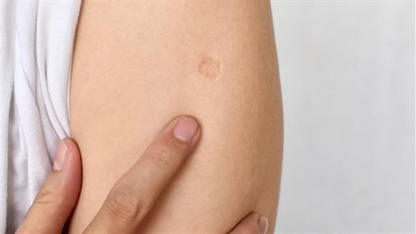 بعد المقطع الصوتي.. بيان حكومي رسمي يكشف حقيقة تفشي مرض الدرن في مصر