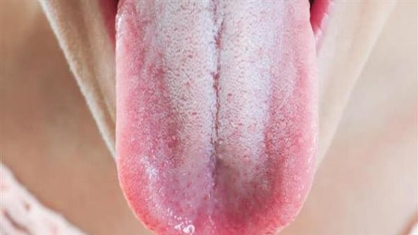  لسانك يعكس صحتك.. 6 علامات تشير إلى الإصابة بأمراض خطيرة