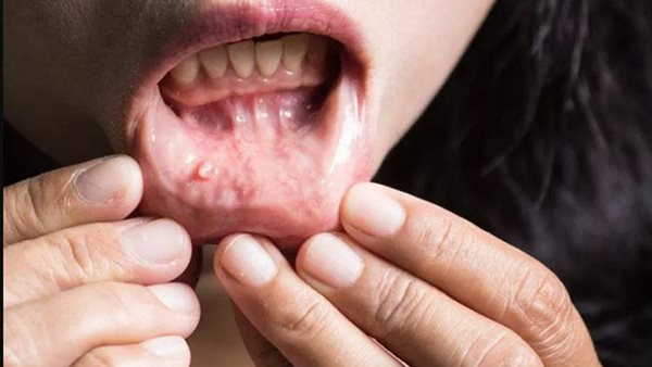 اكتشفها مبكرا.. 7 علامات خفية تدل على نمو سرطاني في فمك