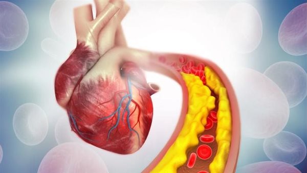 احذرها.. أطعمة تسبب انسداد الشرايين وارتفاع الكوليسترول