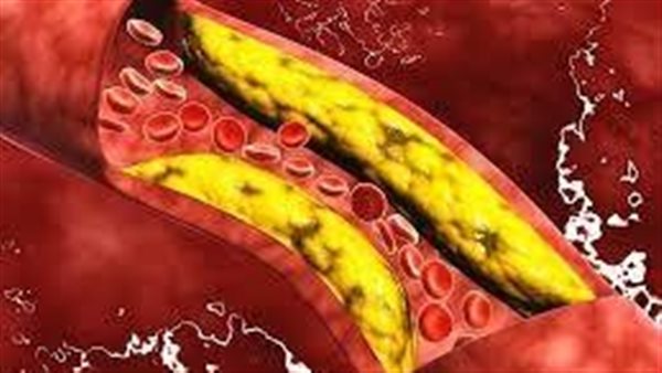 3 أعراض في الأذن احذرها.. علامة على ارتفاع الكوليسترول في الدم