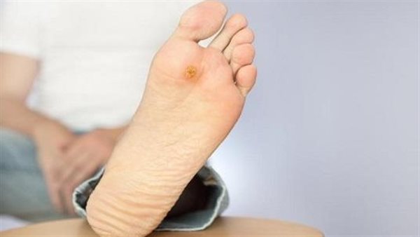 احذرها.. علامات على قدميك تنذرك بالقاتل الصامت 