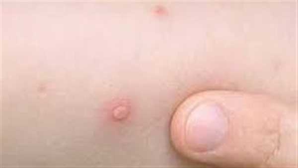 بعد تحذير وزارة التربية والتعليم.. إليك أسباب وأعراض الجدري المائي 